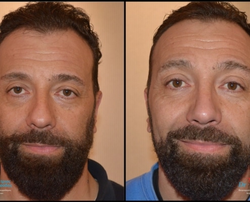 Male rhinoplasty