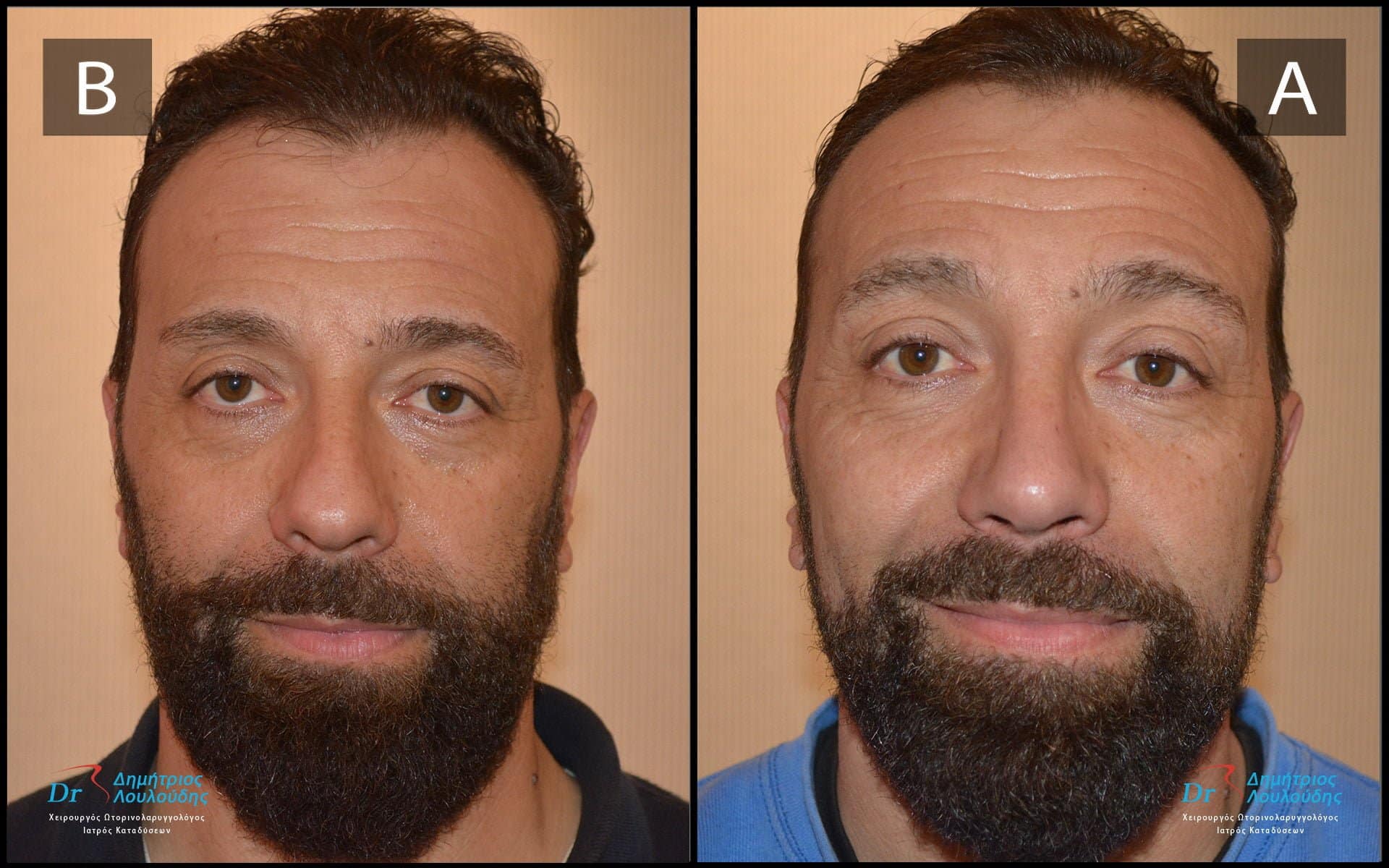 Male rhinoplasty