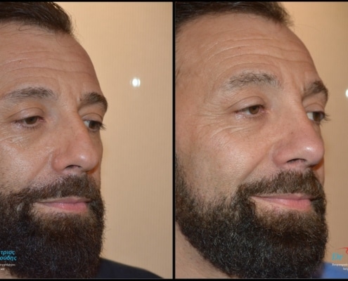 Male rhinoplasty