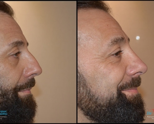 Male rhinoplasty