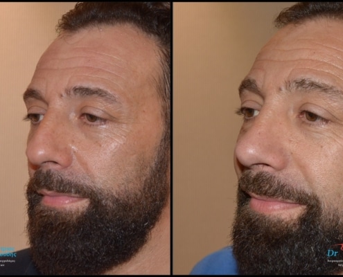 Male rhinoplasty