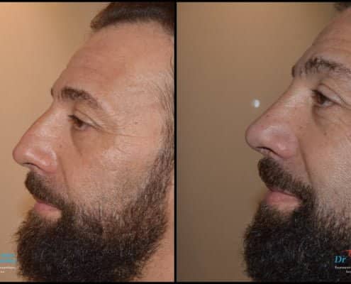 Male rhinoplasty