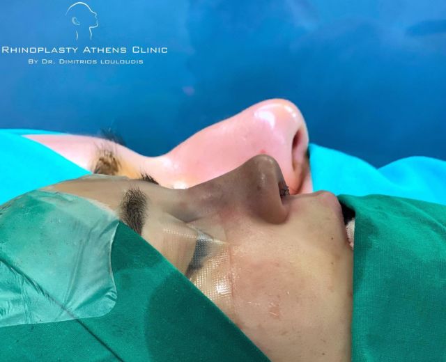 ▫️Immidiate post op.

#RhinoplastyAthensClinic
#Drlouloudis

#rhinoplasty #ρινοπλαστική #ρινοπλαστικη #ρινοπλαστικηαθηνα #ρινοπλαστικήεπέμβαση #septoplasty #septorhinoplasty #primaryrhinoplasty #beforeandafter #rhinoplastyspecialist #nose #nosejob #rhinoplastyathens #drlouloudis
____

📌Για πληροφορίες

☎️2106614140
📱6944370415

" We don’t deliver beautiful noses
We create beautiful faces”