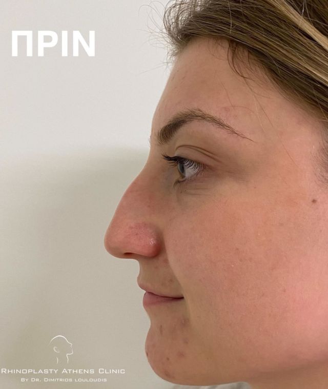 ▫️16 months post op. 
Isn't she a natural beauty?

#RhinoplastyAthensClinic
#Drlouloudis

#rhinoplasty #ρινοπλαστική #ρινοπλαστικη #ρινοπλαστικηαθηνα #ρινοπλαστικήεπέμβαση #septoplasty #septorhinoplasty #primaryrhinoplasty #beforeandafter #rhinoplastyspecialist #nose #nosejob #rhinoplastyathens #drlouloudis
____

📌Για πληροφορίες

☎️2106614140
📱6944370415

" We don’t deliver beautiful noses
We create beautiful faces "