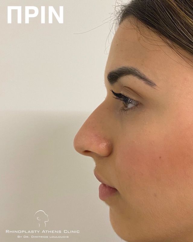 ▫️1 year post op.
Be yourself, at it's very best!

#RhinoplastyAthensClinic
#Drlouloudis

#rhinoplasty #ρινοπλαστική #ρινοπλαστικη #ρινοπλαστικηαθηνα #ρινοπλαστικήεπέμβαση #septoplasty #septorhinoplasty #primaryrhinoplasty #beforeandafter #rhinoplastyspecialist #nose #nosejob #rhinoplastyathens #drlouloudis
____

📌Για πληροφορίες

☎️2106614140
📱6944370415

" We don’t deliver beautiful noses
We create beautiful faces "