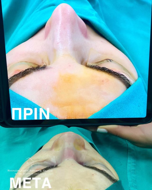 ▫️Immidiate post op.

#RhinoplastyAthensClinic
#Drlouloudis

#rhinoplasty #ρινοπλαστική #ρινοπλαστικη #ρινοπλαστικηαθηνα #ρινοπλαστικήεπέμβαση #septoplasty #septorhinoplasty #primaryrhinoplasty #beforeandafter #rhinoplastyspecialist #nose #nosejob #rhinoplastyathens #drlouloudis
____

📌Για πληροφορίες

☎️2106614140
📱6944370415

" We don’t deliver beautiful noses
We create beautiful faces”